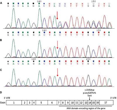 Novel de novo SPAST mutation in a Han Chinese SPG4 patient: a case report